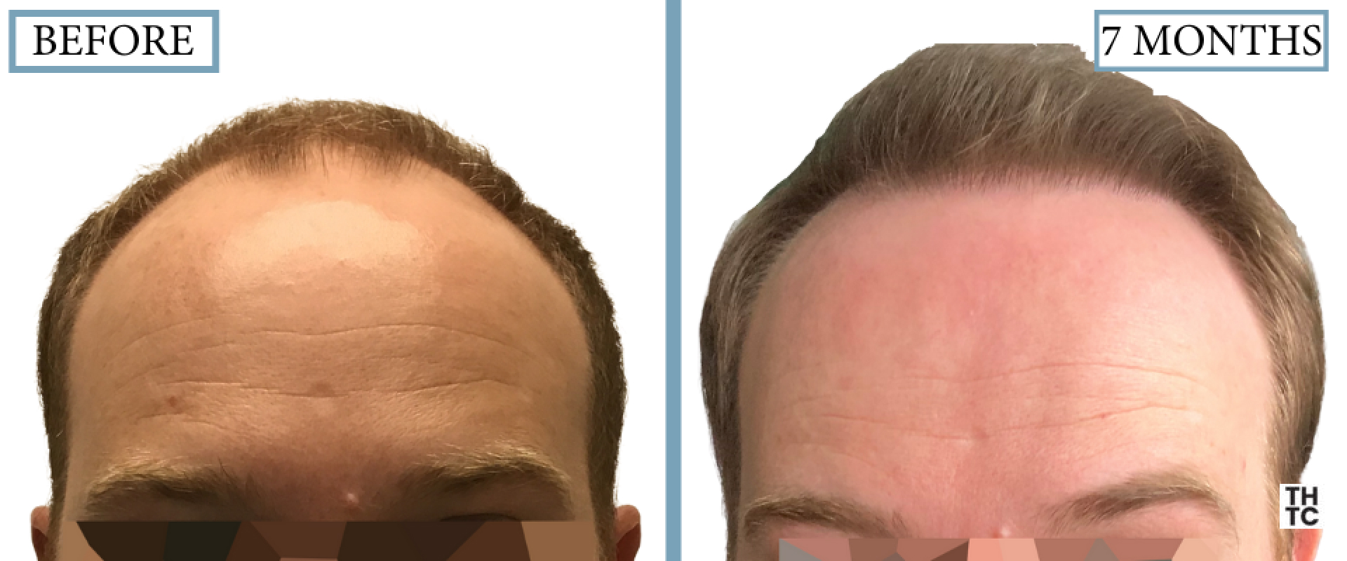 Hair Transplant Toronto